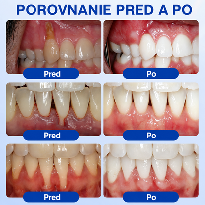 👨‍⚕️Evolvion® GumRevive regeneračný gél na parodont🦷